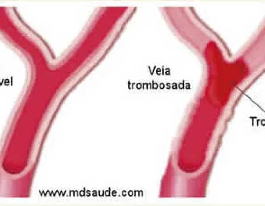 Trombose Venosa Profunda: Um Guia Informativo